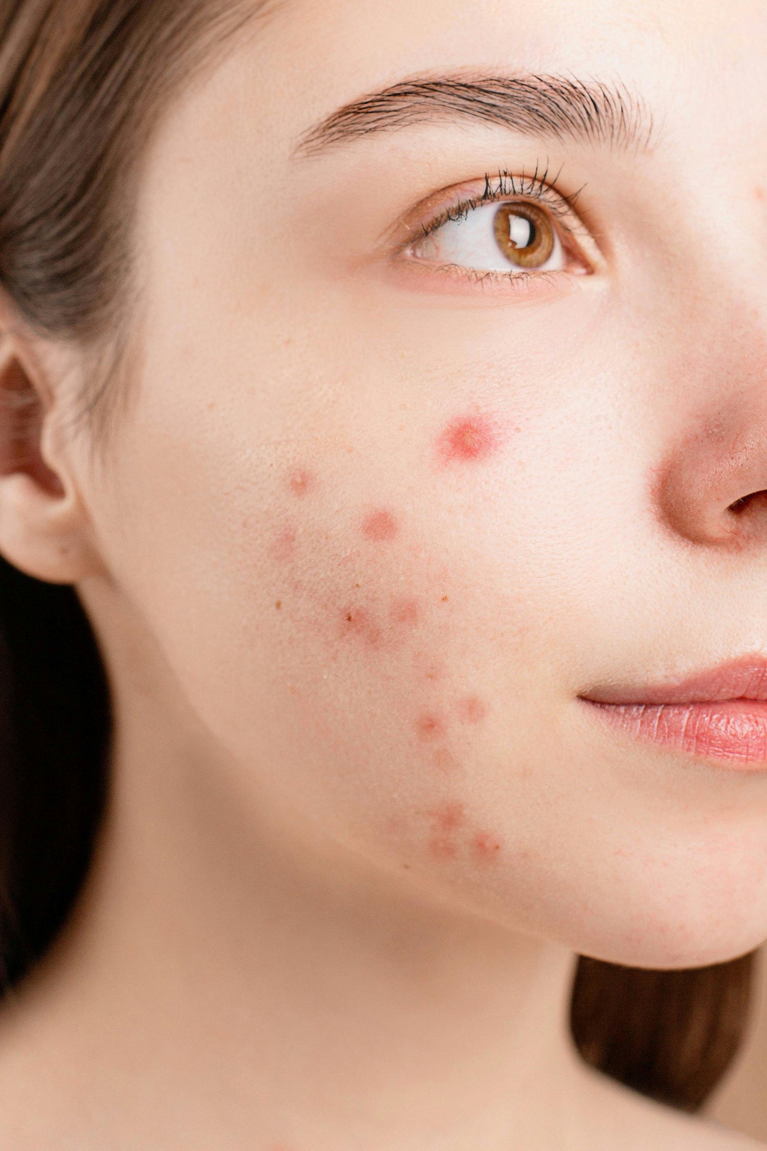 Acne – Glow